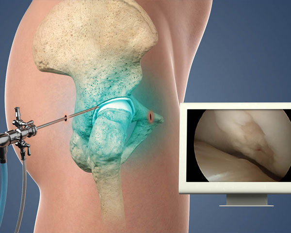 hip-arthroscopy hip-arthroscopy