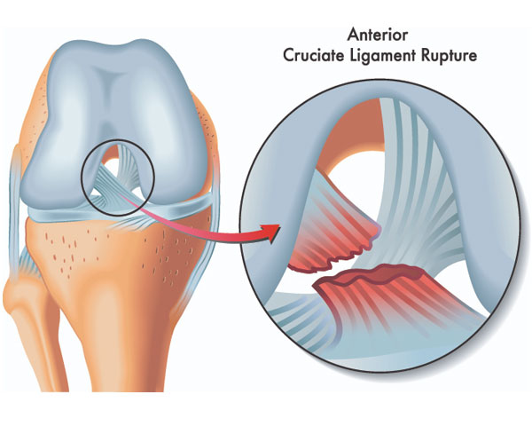 ligament-injury ligament-injury