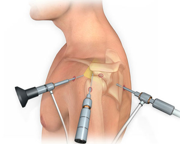 shoulder-arthroscopy shoulder-arthroscopy